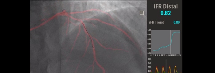 Dynamic Coronary Roadmap