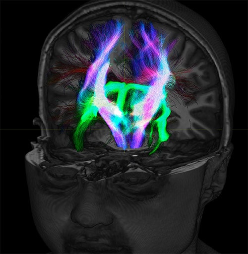 Studying Connectivity Between Brain Regions FieldStrength Philips