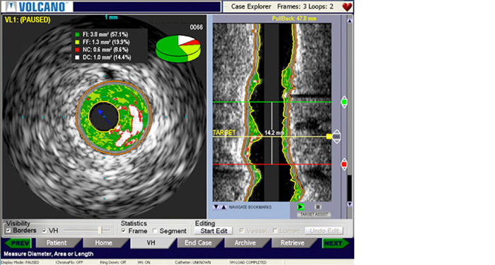 VhIvus LesionAssessment