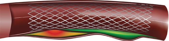 Grayscale IVUS vs VH IVUS