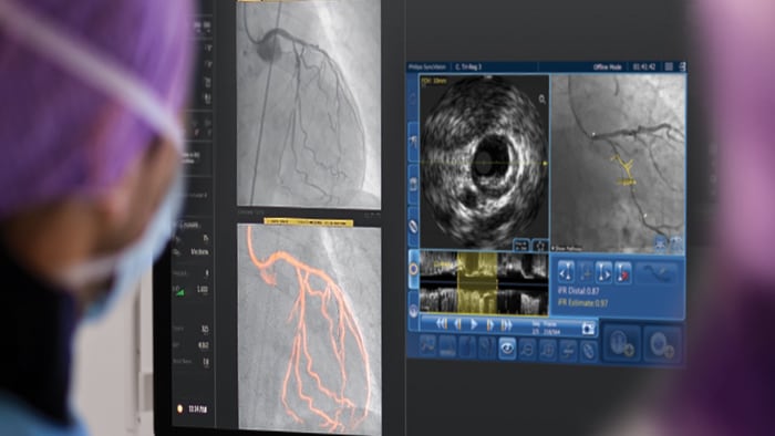 Advanced IVUS Imaging Technology 