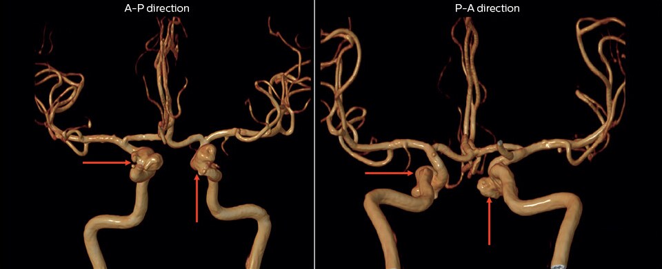 mr angiography of multiple cerebral aneurysms