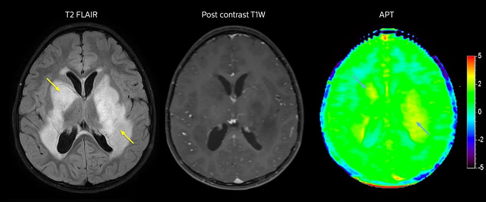 APT imaging of low-grade tumor
