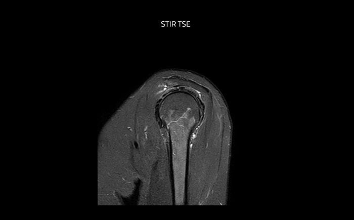 Shoulder MRI with high quality, STIR TSE