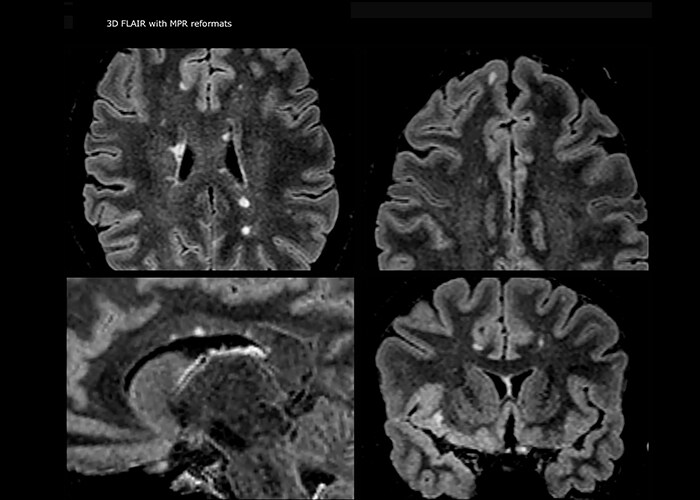 Mri In Ms Stroke Brain Tumor Fieldstrength Mri Philips Healthcare