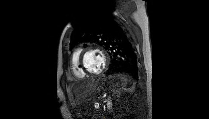 MRI of heart with MR Conditional ICD