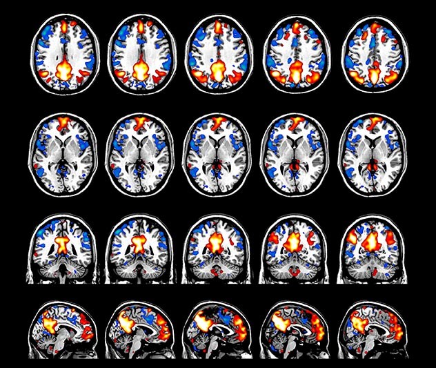 MultiBand SENSE resting state MRI ALFA, Gispert