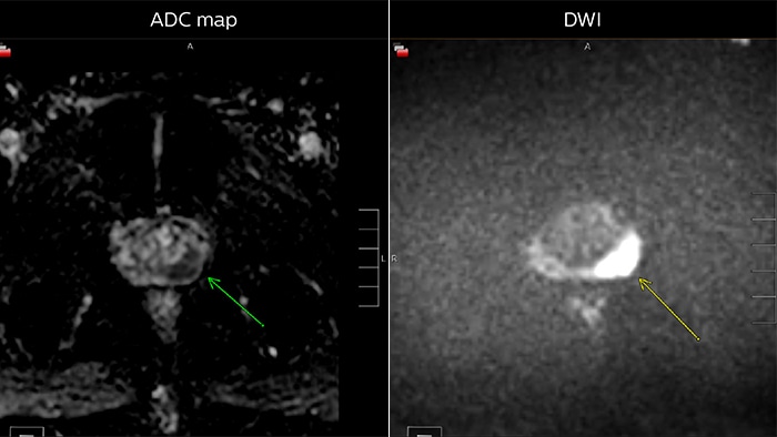 ADC Map vs DWI