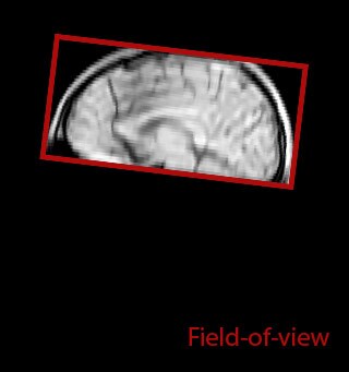 Myelin water imaging with SENSE