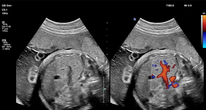 C5-1 Liver CFI MaxVue