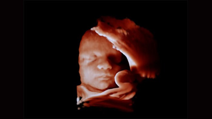 3D ultrasound image with obstetric ultrasound