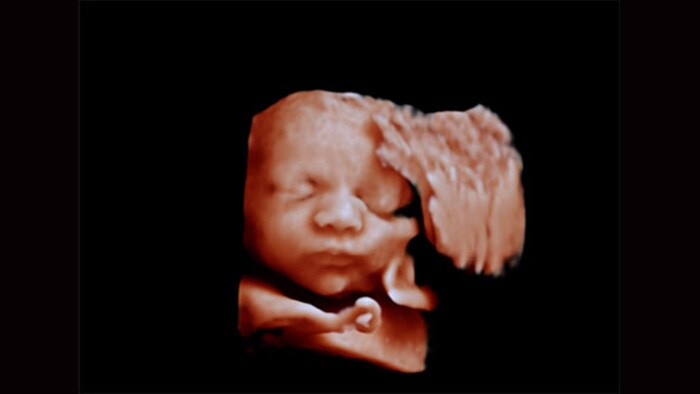 Second fetal face 3D ultrasound image with aReveal