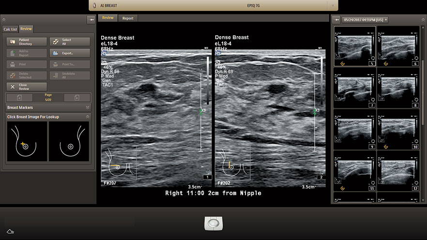 eL18-4 AI Dense Breast Find Orthogonal