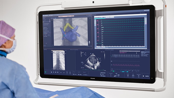 Atrial fibrillation procedures