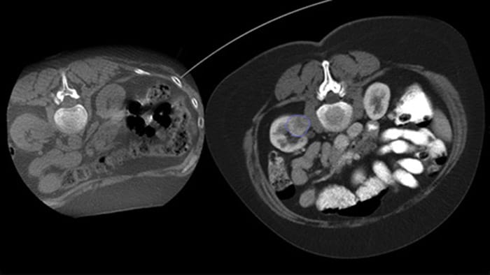 Lesion imaging with CBCT