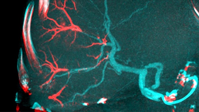 Pre-and Post-embolization 3D image fusion with Dual View