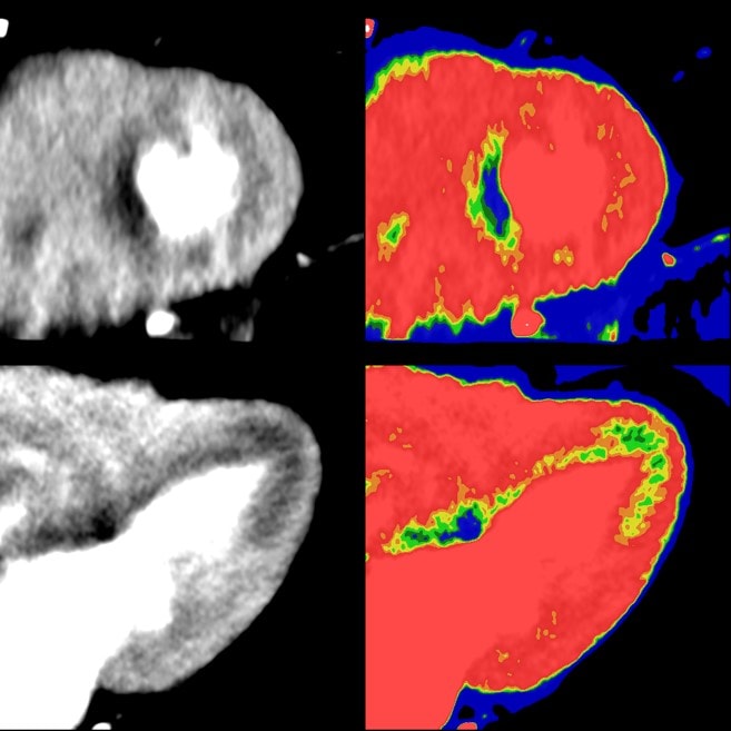 Myocardial perfusion