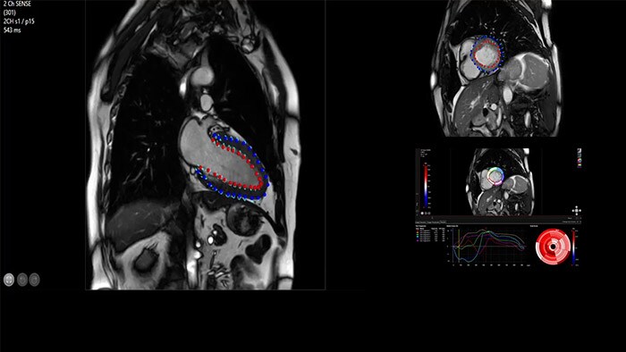 Quantify Myocardial Strain