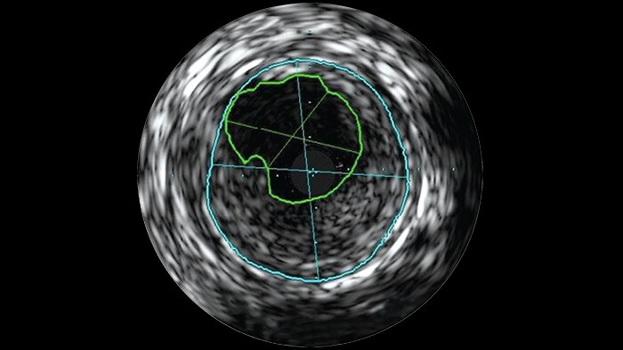 Intravascular ultrasound (IVUS)