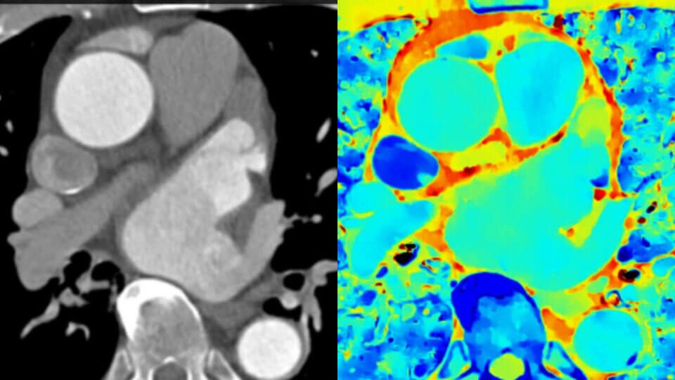 Conventional CT clinical image compared with spectral-detector CT clinical image