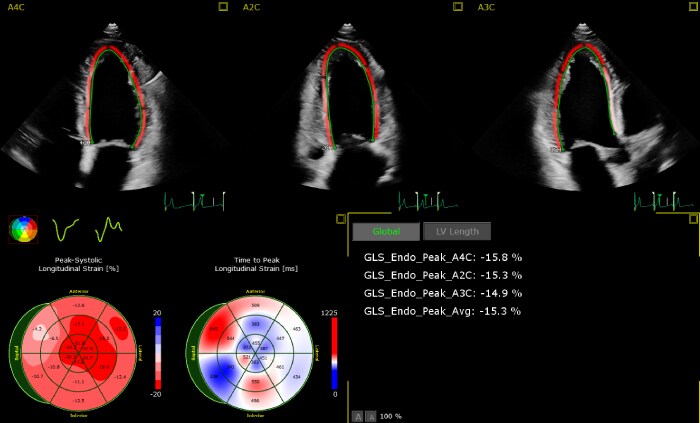 Philips AutoStrain