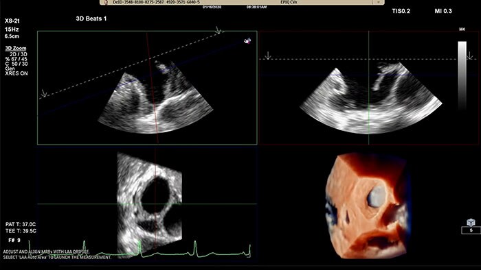 The Philips LAA solution on EPIQ CVx