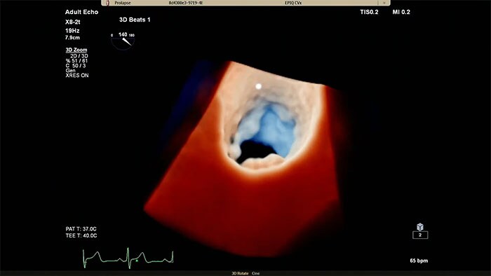 Philips Cardiac TrueVue on EPIQ CVx.