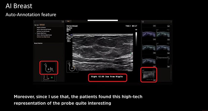 Breast cancer high tech treatments