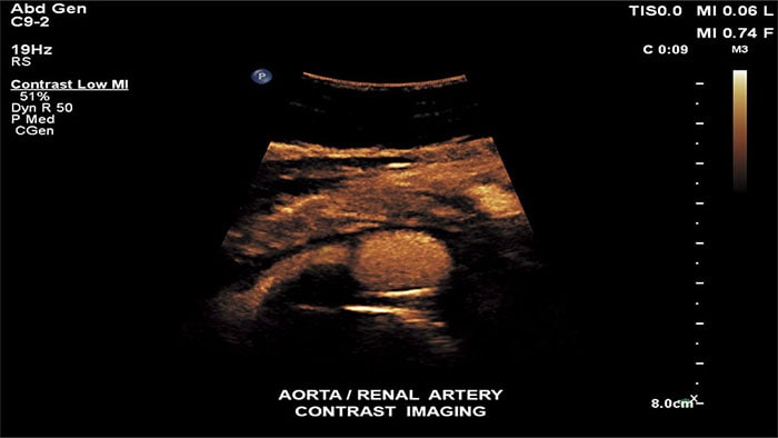 Image with the renal contr ultrasound