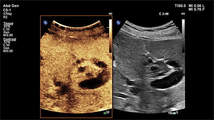 Image with the liver ultrasound