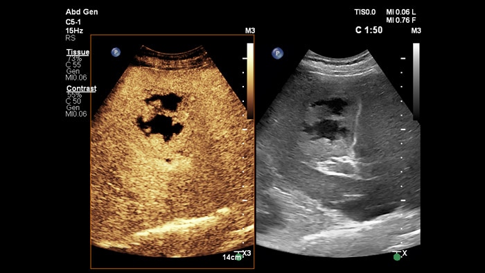 EPIQ CM9 contrast SBS liver lesion