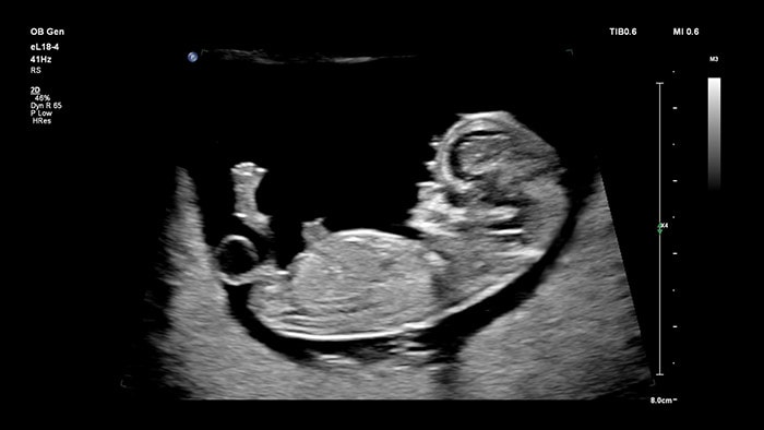 Fetal profile with eL18-4 OB ultrasound machine