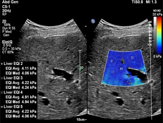 EPIQ_Normal Liver with multiple measurements_ElastQ