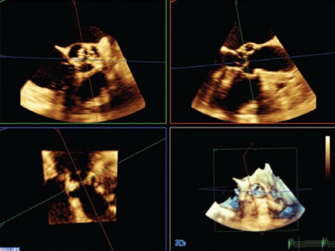 Structural Heart Disease