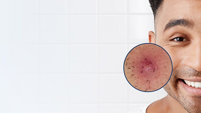 Make pimples a thing of the past